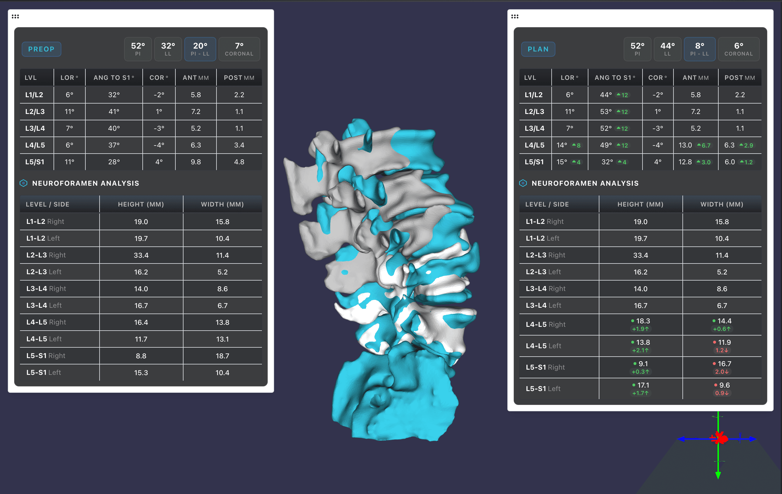 Pre-op vs. surgical plan comparison with neuroforamen analysis